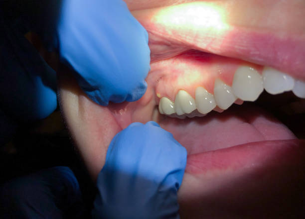 Best Emergency Denture Repair in Versailles, MO